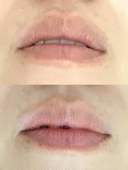 ドクターメラニン ラボ トーキョー 渋谷(Dr. Melanin Labo TOKYO)/唇メラニンケア症例