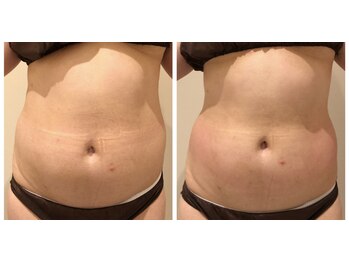 エイシスグロウ(asis glow.)/効果写真