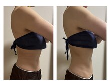 ヘルスアンドビューティー シーズスパ(CSY's SPA)/インディバでお腹周りの脂肪撃退