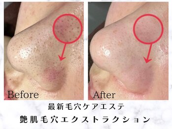 リモア(REMORE.)/艶肌毛穴エクストラクション B/A