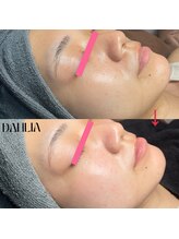 ダリア(Dahlia)/ハーブピーリング