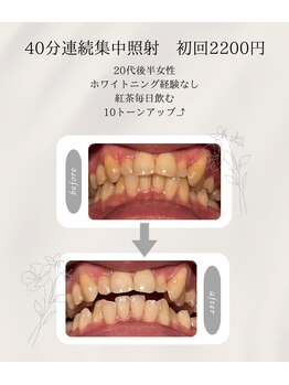 プラスビーセルフ(+b self)/ホワイトニングビフォーアフター
