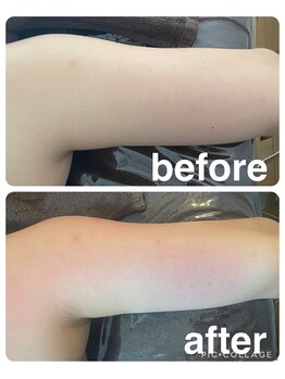 ギンザアール(GINZA R.)/二の腕にアプローチ！