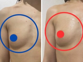 ポインセチア(Poinsettia)/施術回数3回の効果/並び比較