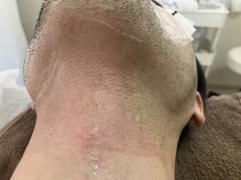 グランデ(GRANDE)/ヒゲデザイン脱毛