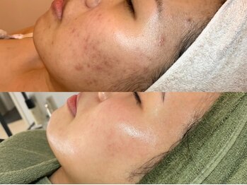 ピブ(PIBU)/ニキビ症例/ハーブピーリング