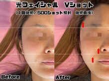 ヴィオール 名古屋栄店(VIOR)/光フェイシャル　Vショット！