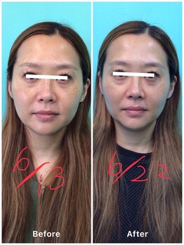 高宮レディース鍼灸整骨院/小顔矯正before&after