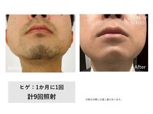 ザ エッセンシャル 碧南(THE Essential)/メンズ　ヒゲ脱毛