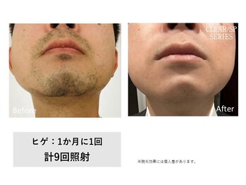 ザ エッセンシャル 碧南(THE Essential)/メンズ ヒゲ脱毛