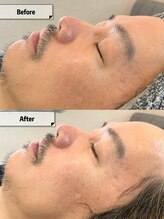 サムライビューティー 新宿三丁目店(SamuraiBeauty)/お肌の角質、お肌改善！