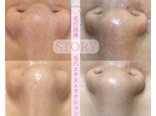 毛穴洗浄・毛穴エクストラクション≪眉毛/うぶ毛/艶肌WAX/毛穴≫