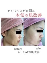 アマン(AMANN.)/肌改善フェイシャル☆