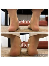 ポドウオーク(PODO WALK)/足首の変形