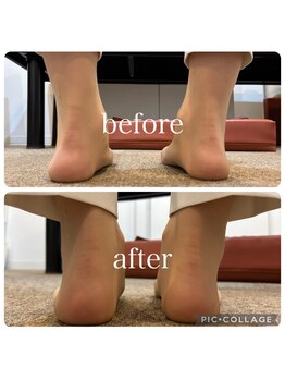 ポドウオーク(PODO WALK)/足首の変形