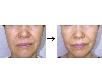 ドクターエイジレス(DR.AGELESS)/バイオセルショットコース6回