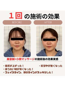 クローバー鍼灸整骨院/美容鍼+小顔矯正マッサージ　