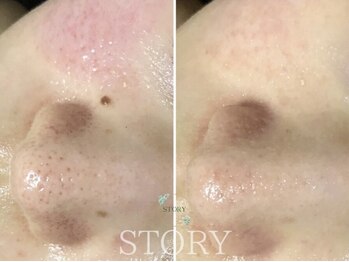 ストーリー 岐阜店(STORY)/ハーブピーリング専門店STORY