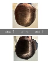 青空 天神大名店(SORA)/マイクロチップ頭皮5回