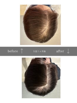 青空 天神大名店(SORA)/マイクロチップ頭皮5回