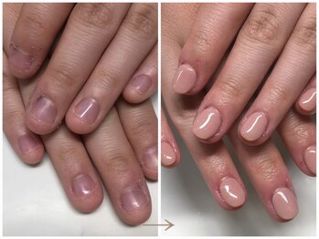 キュアネイル(Qa Nail)/ハンド【深爪矯正】初日変化！