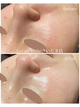 ルタンリッシュ さいたま店(Lutan Riche)/陶肌トリートメント 毛穴ケア