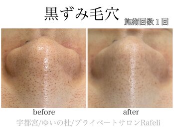 ラフェリ(Rafeli)/黒ずみ毛穴