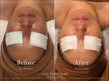 アイラブワン 大和 南林間店(eye love one)の写真/【あらゆる肌のお悩み改善★】光フォトでお肌にアプローチ！ベテランスタッフ揃いで初めての方もおすすめ♪