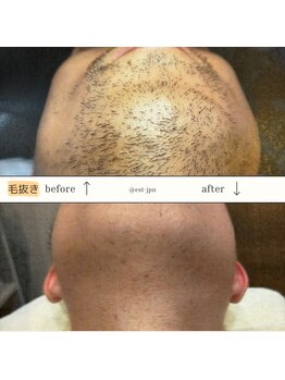 エスト(Est_.)/美容電気脱毛【毛抜き】