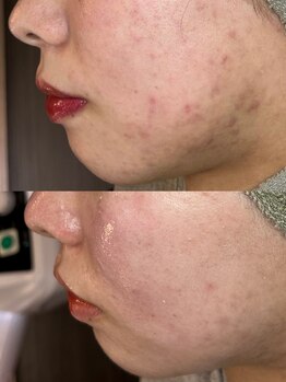 フルール ニコ(Fleur Nico)/3回のBeforeAfter