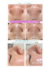 クレヴィー(Creviy)/韓国式3D毛穴洗浄×ハーブ