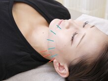 GIG整骨院/鍼灸師在籍！人気の美容鍼♪