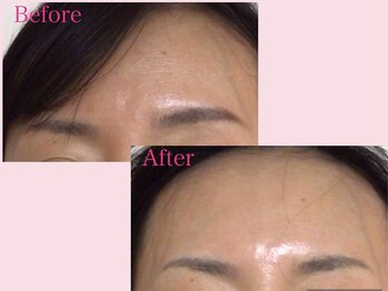 サロン ジョリー(Salon Jolie)/シワ改善にはポテンツァ