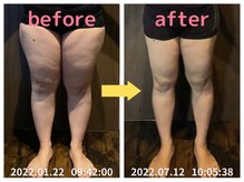 美容整体院元 光の森店/ダイエット6ヶ月　before&after
