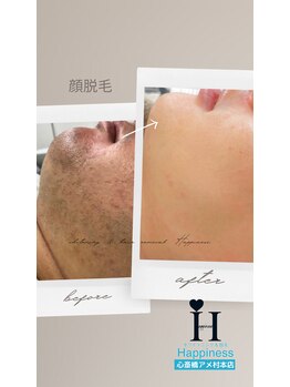 ハピネス 心斎橋アメリカ村本店(Happiness)/ヒゲ脱毛Before→After