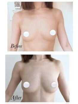 美人バスト 札幌店/バストアップ×育乳◇症例◇