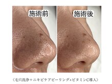 アロマ(AROMA)/黒ずみ毛穴(3)