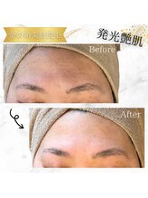 カリス(charis)/金の糸美肌脱毛