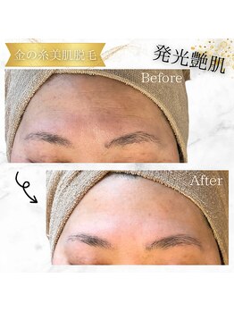 カリス(charis)/金の糸美肌脱毛