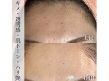 エクレ(eclat)/お肌トラブル根本改善♪