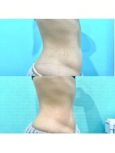 カンナムビューティー/オンダリフト/表参道/ララピール