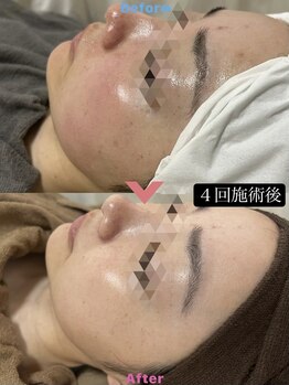 雅凪/ハーブピーリング ビフォアフ