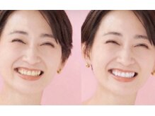 ホワイト 香里園店(WHITE)の雰囲気（歯の色でここまで印象を変えれる◎若々しい印象に）