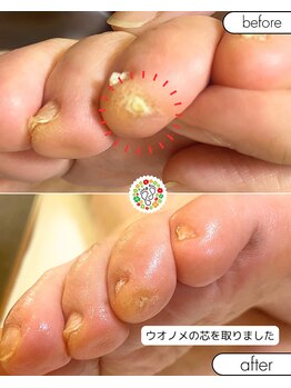 フローラ(Flora)/痛い魚の目お任せください