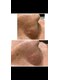 エクシア(excia)の写真/メディアクア毛穴洗浄と炭酸贅沢美容液導入で黒ずみやザラつきをケアし透明感あふれる美肌へ♪
