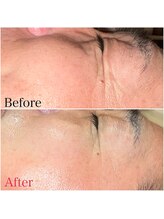 ビューティースタイリング 自由が丘店(beauty styling)/【剥離のないハーブピーリング】