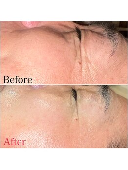 ビューティースタイリング 自由が丘店(beauty styling)/【剥離のないハーブピーリング】