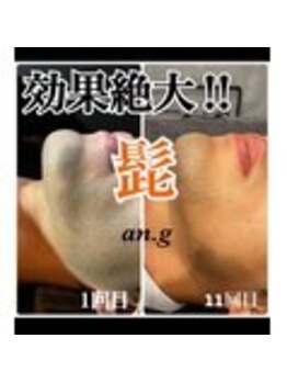 アンジー(an.g)/【福山市脱毛】ヒゲ脱毛