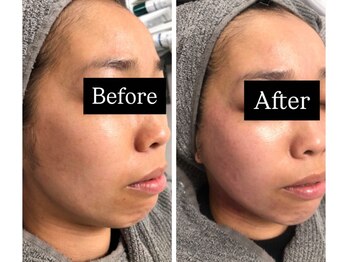 ルキア(LUKIA)/超最新リフトアップ技術！