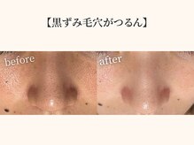 ドリームスパ 武蔵小杉店(DREAM SPA)/毛穴吸引＋引き締めパック＋導入